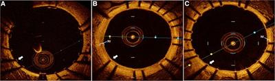 Dipyridamole and vascular healing following stent implantation